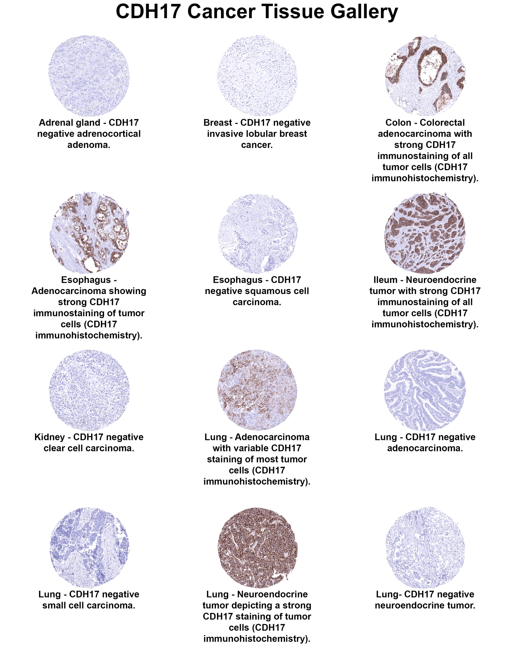 Cadherin-17 Antibody (MSVA-517M) - Azide and BSA Free Cadherin-17 Antibody (MSVA-517M) - Azide and BSA Free Cadherin-17 Cancer Tissue Gallery