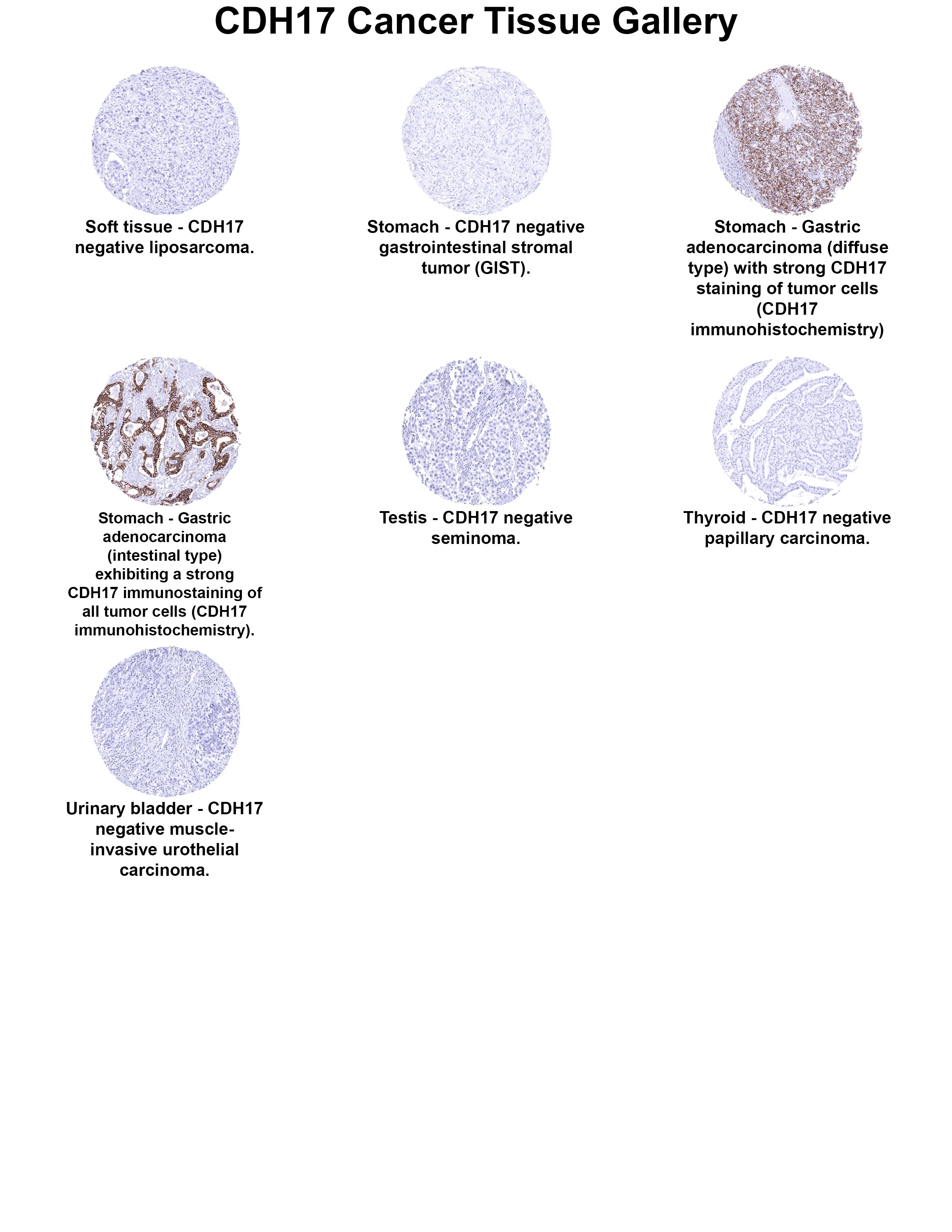Cadherin-17 Antibody (MSVA-517M) - Azide and BSA Free Cadherin-17 Antibody (MSVA-517M) - Azide and BSA Free Cadherin-17 Cancer Tissue Gallery