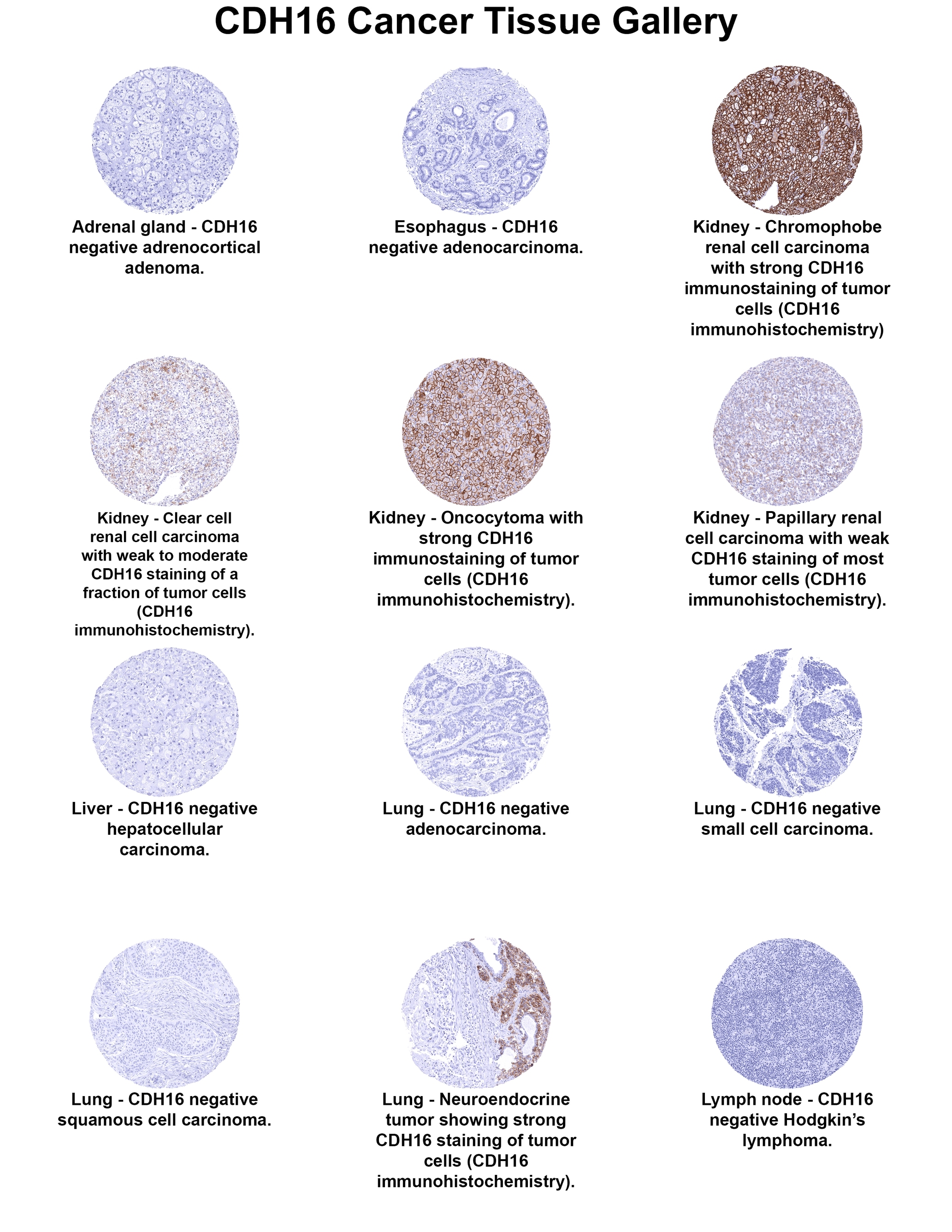 Cadherin-16 Antibody (MSVA-516R) - Azide and BSA Free Cadherin-16 Antibody (MSVA-516R) - Azide and BSA Free Cadherin-16 Cancer Tissue Gallery