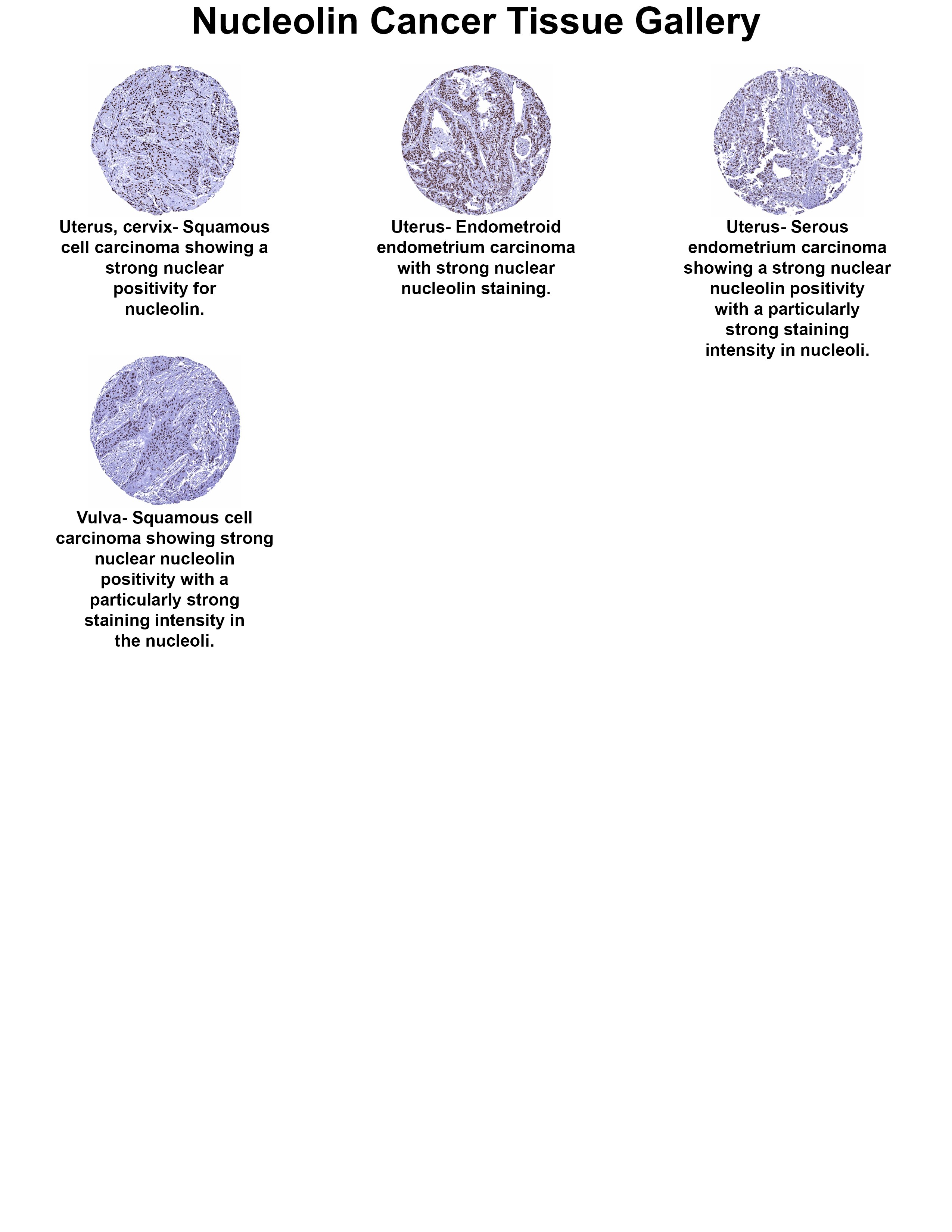 Nucleolin Antibody (MSVA-623R) - Azide and BSA Free Nucleolin Antibody (MSVA-623R) - Azide and BSA Free Nucleolin Cancer Tissue Gallery