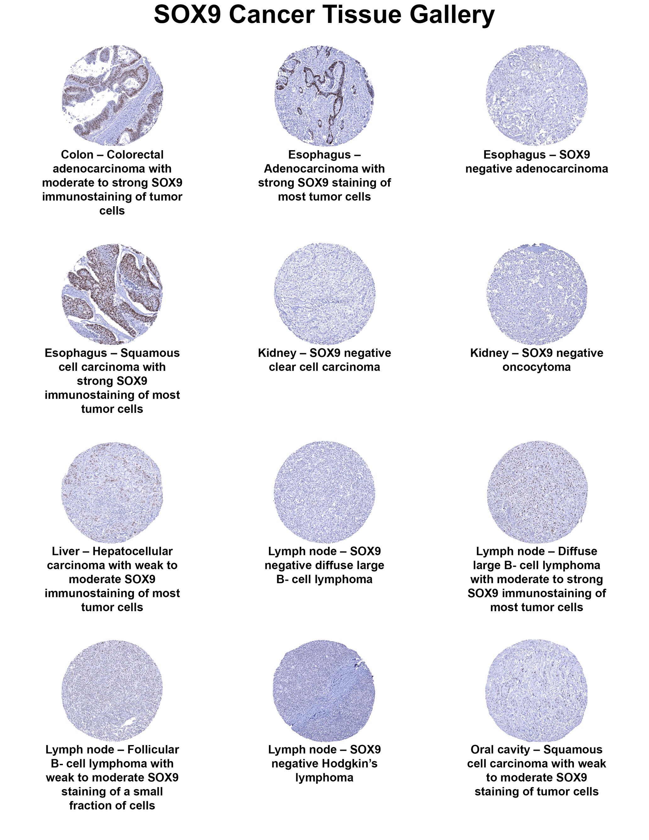 SOX9 Antibody (MSVA-709R) - Azide and BSA Free SOX9 Antibody (MSVA-709R) - Azide and BSA Free SOX9 Cancer Tissue Gallery