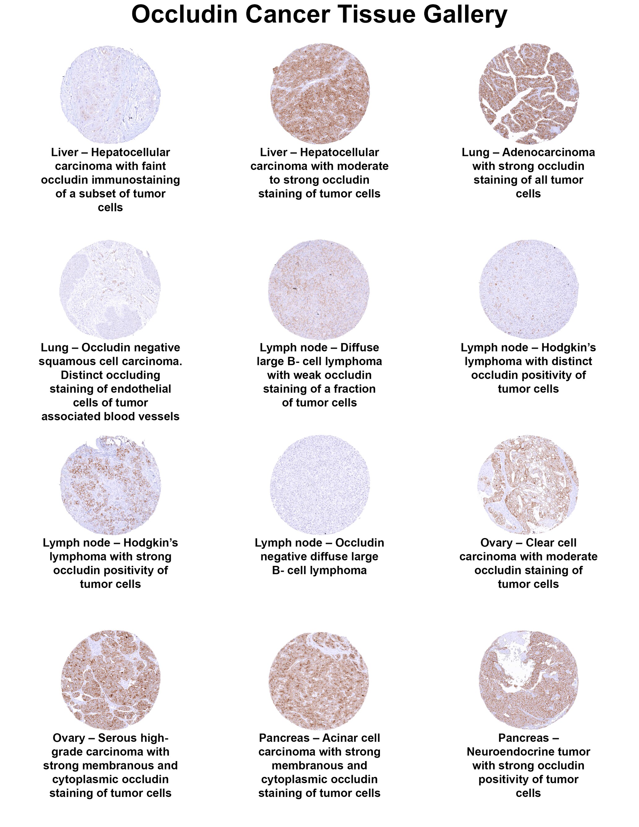Occludin Antibody (MSVA-415M) - Azide and BSA Free Occludin Antibody (MSVA-415M) - Azide and BSA Free Occludin Cancer Tissue Gallery