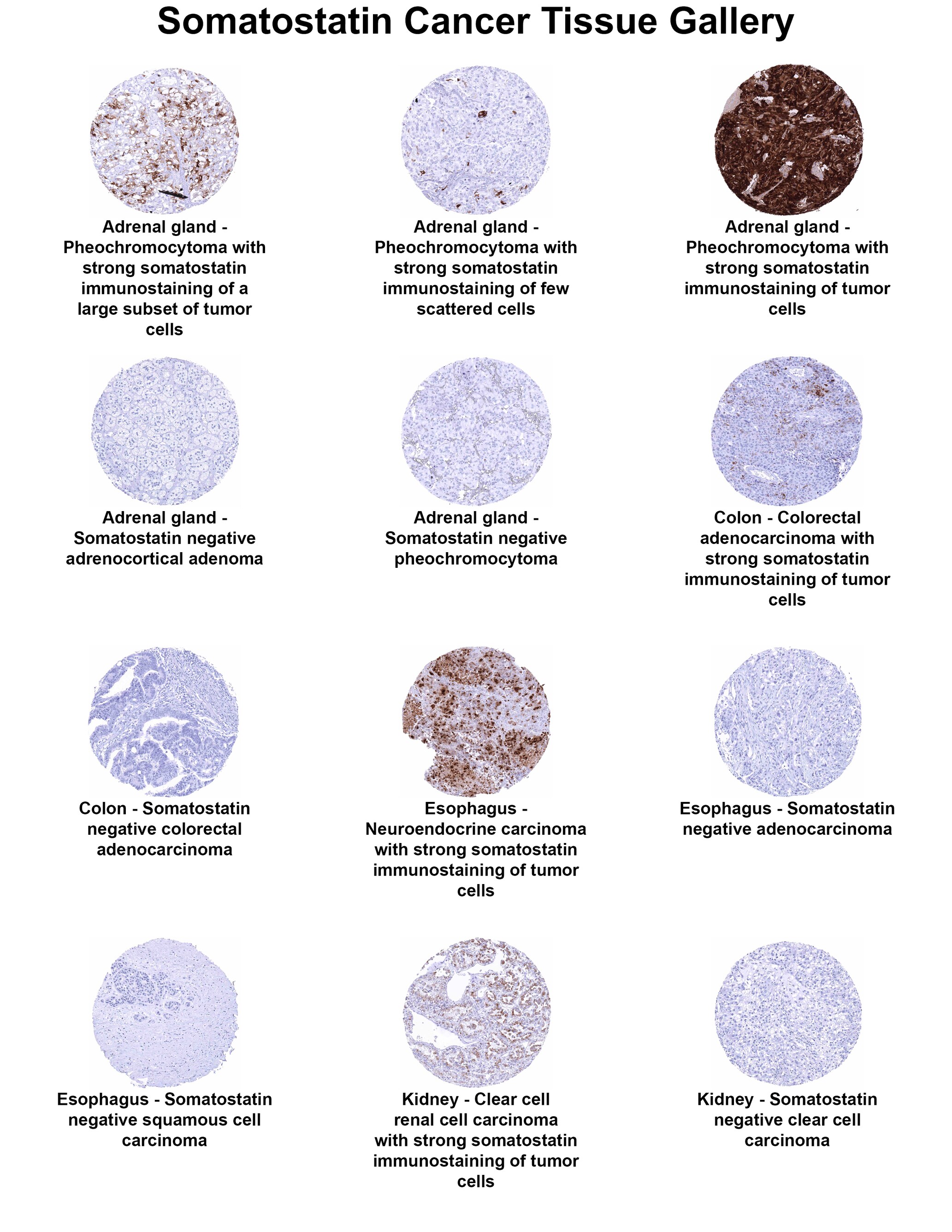 Somatostatin Antibody (MSVA-638R) - Azide and BSA Free Somatostatin Antibody (MSVA-638R) - Azide and BSA Free Somatostatin Cancer Tissue Gallery
