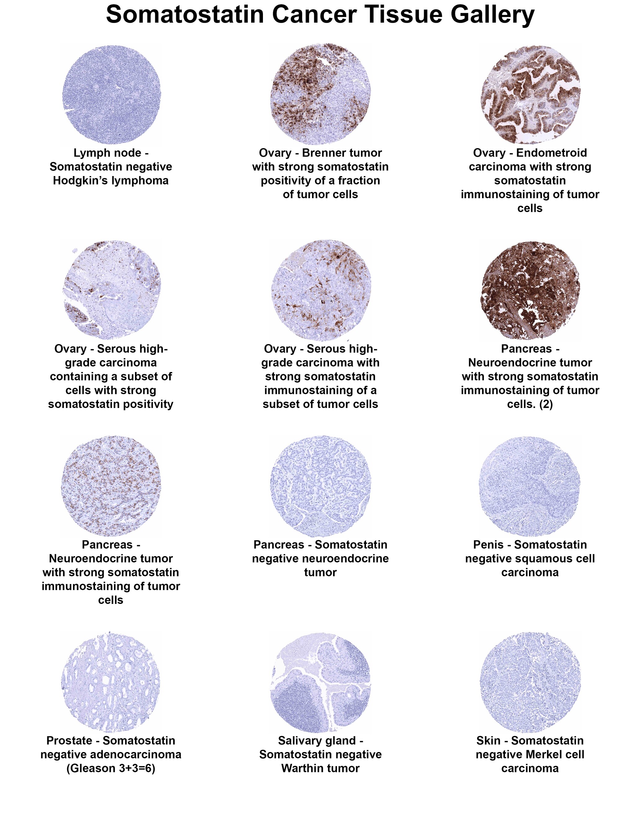 Somatostatin Antibody (MSVA-638R) - Azide and BSA Free Somatostatin Antibody (MSVA-638R) - Azide and BSA Free Somatostatin Cancer Tissue Gallery