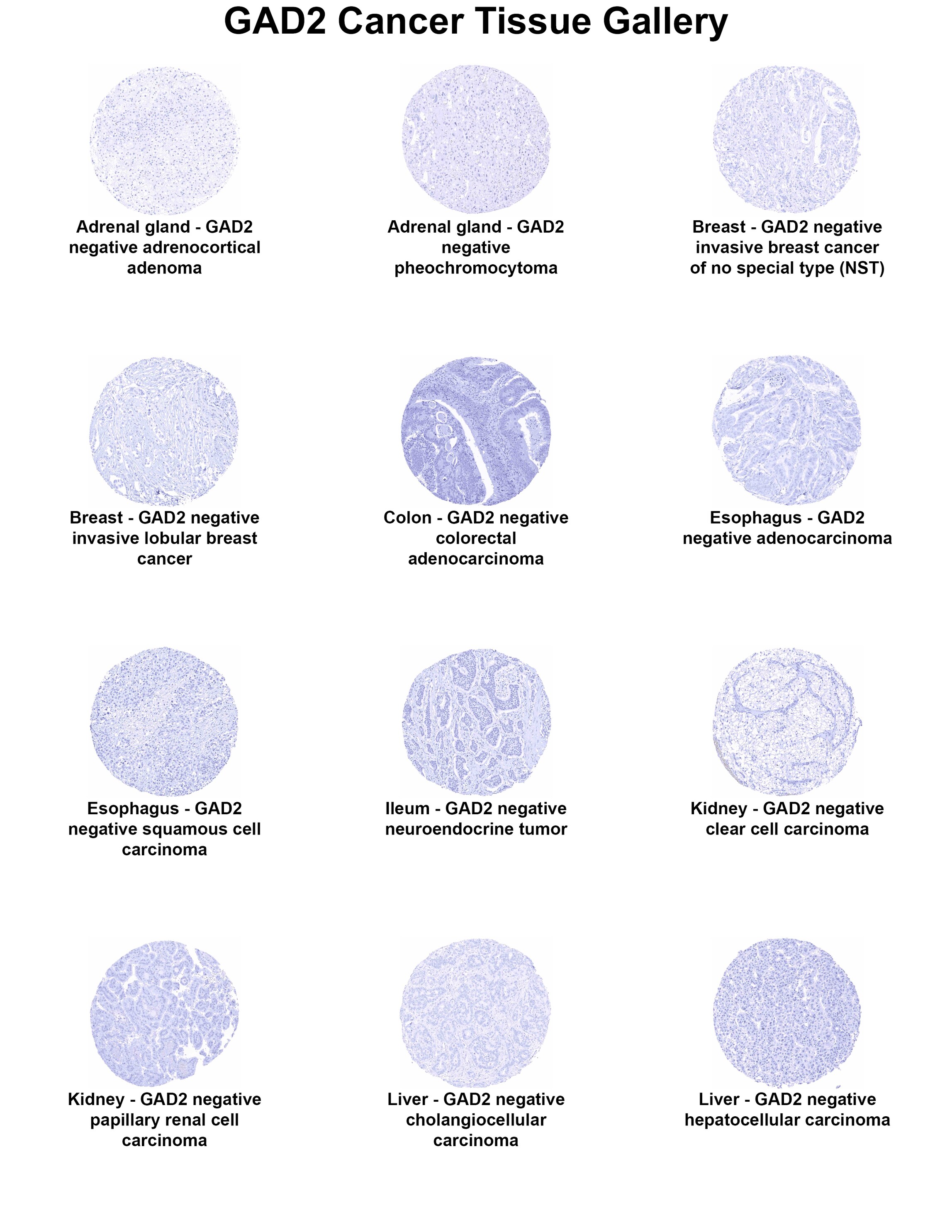 GAD2/GAD65 Antibody (MSVA-602M) - Azide and BSA Free GAD2/GAD65 Antibody (MSVA-602M) - Azide and BSA Free GAD2/GAD65 Cancer Tissue Gallery