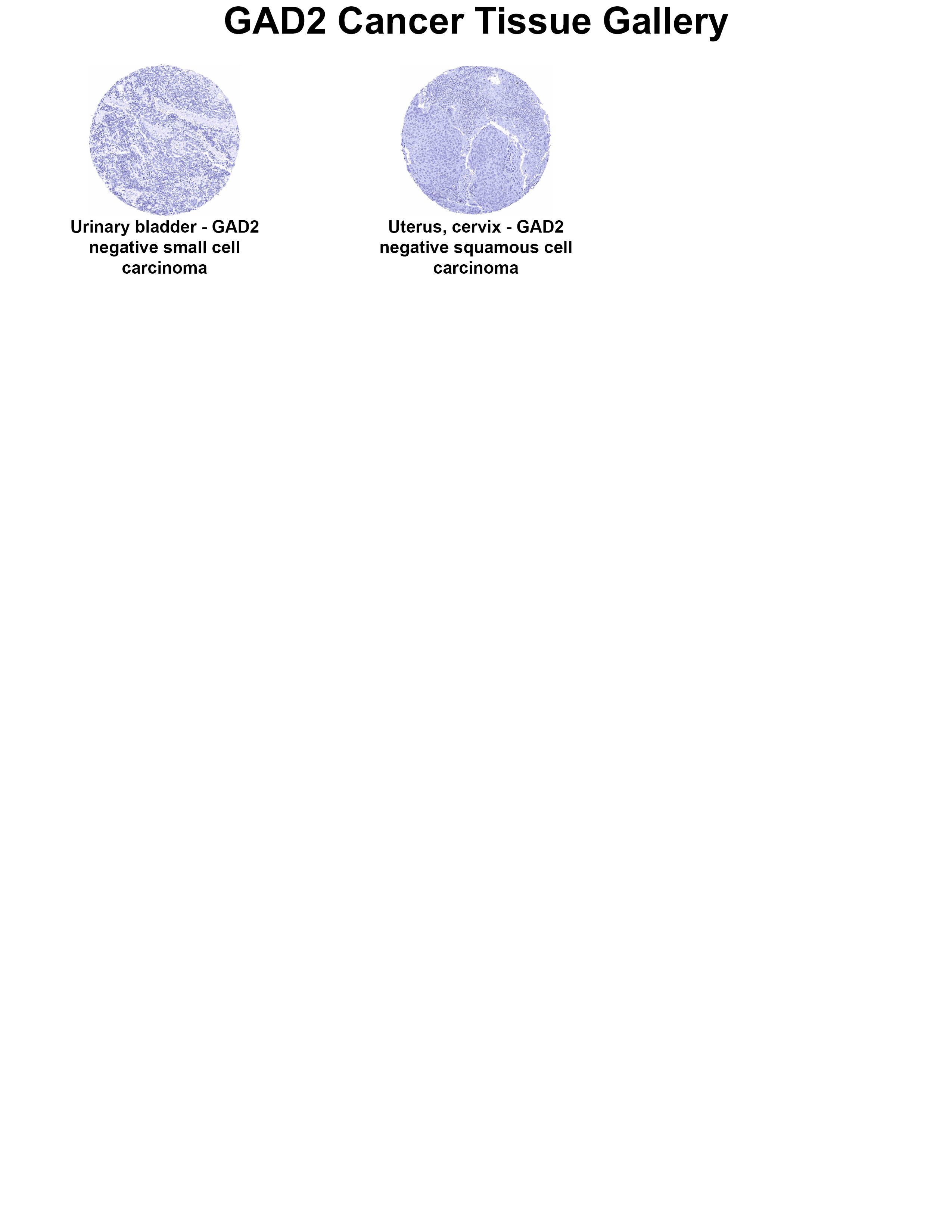 GAD2/GAD65 Antibody (MSVA-602M) - Azide and BSA Free GAD2/GAD65 Antibody (MSVA-602M) - Azide and BSA Free GAD2/GAD65 Cancer Tissue Gallery