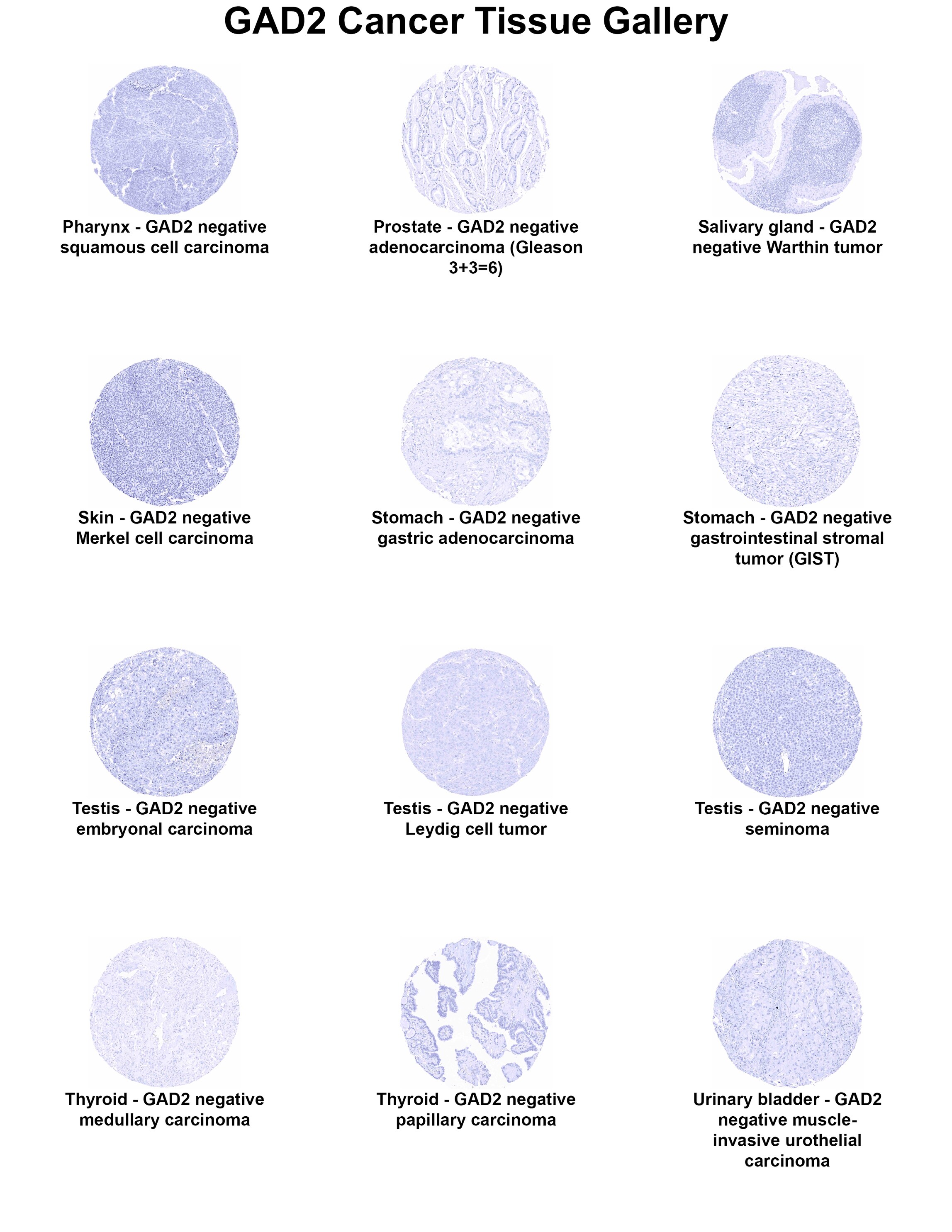 GAD2/GAD65 Antibody (MSVA-602M) - Azide and BSA Free GAD2/GAD65 Antibody (MSVA-602M) - Azide and BSA Free GAD2/GAD65 Cancer Tissue Gallery