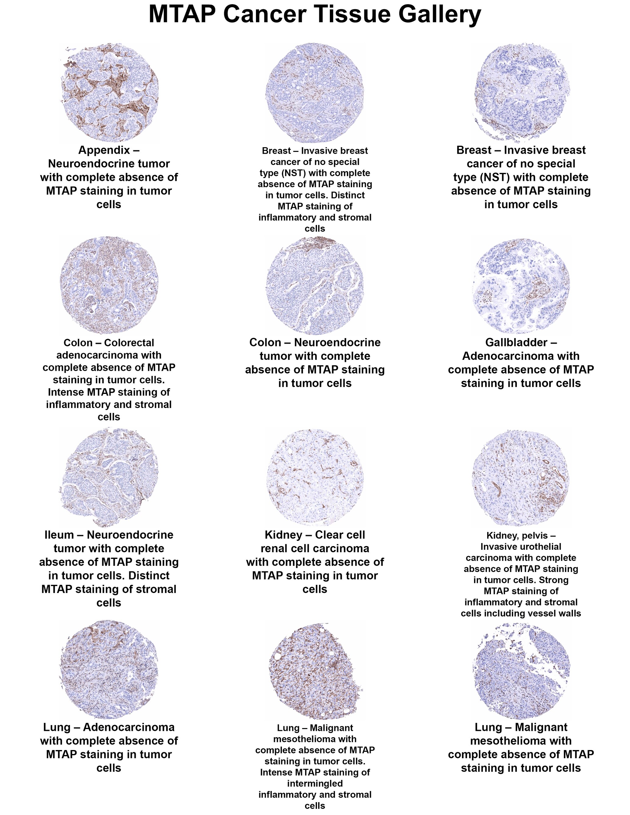MTAP Antibody (MSVA-741R) - Azide and BSA Free MTAP Antibody (MSVA-741R) - Azide and BSA Free MTAP Cancer Tissue Gallery