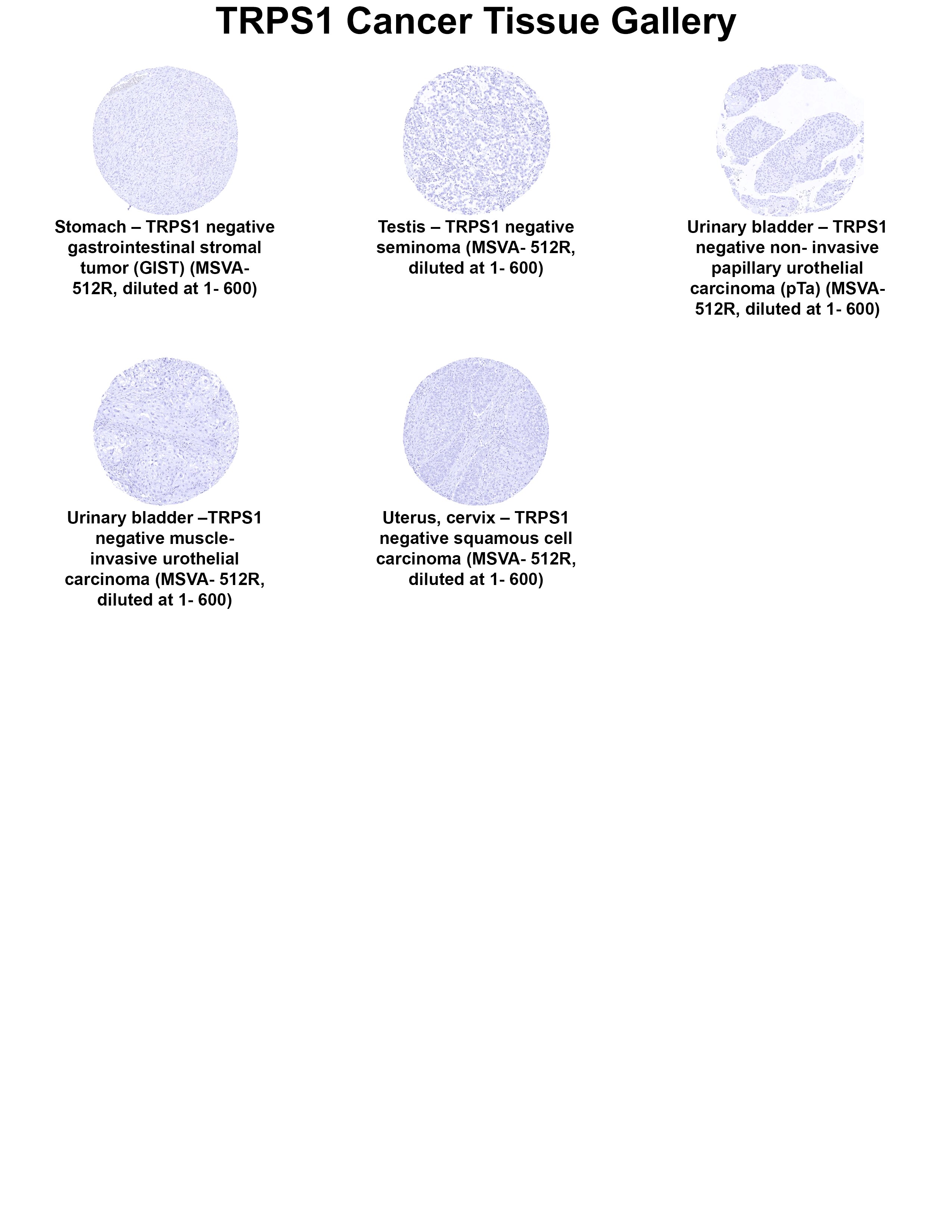 TRPS1 Antibody (MSVA-512R) - Azide and BSA Free TRPS1 Antibody (MSVA-512R) - Azide and BSA Free TRPS1 Cancer Tissue Gallery