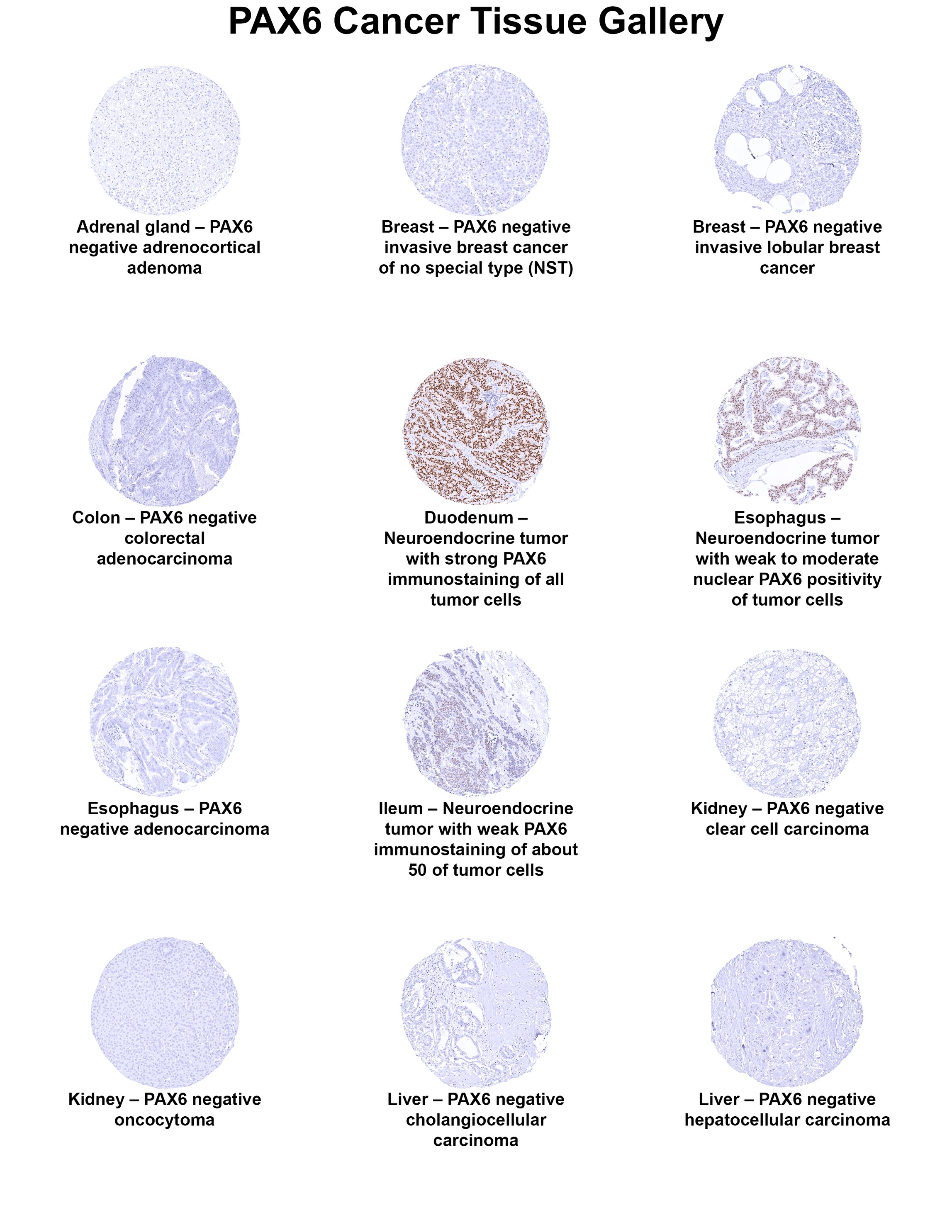 Pax6 Antibody (MSVA-706M) - Azide and BSA Free Pax6 Antibody (MSVA-706M) - Azide and BSA Free Pax6 Cancer Tissue Gallery