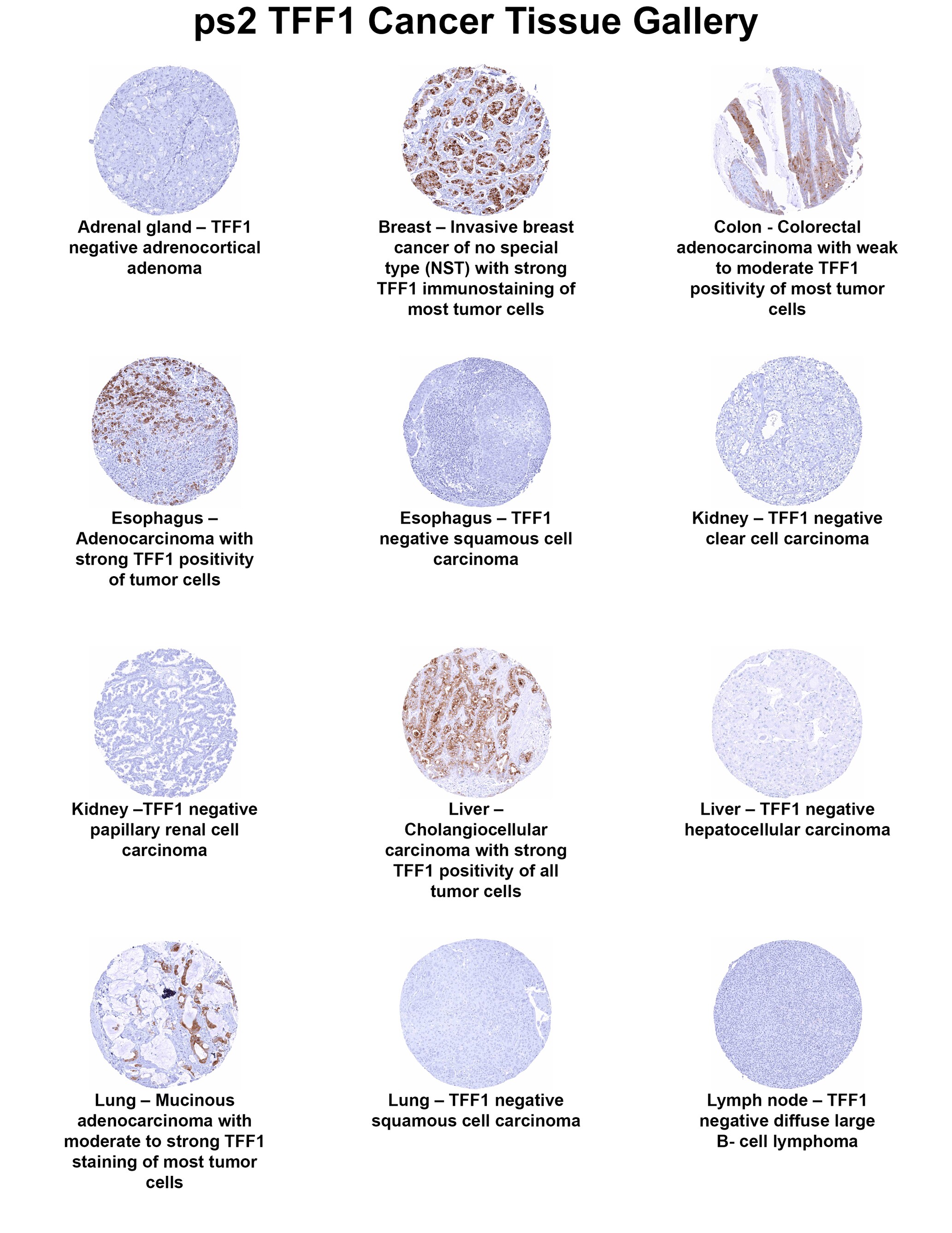 TFF1/pS2 Antibody (MSVA-482M) - Azide and BSA Free TFF1/pS2 Antibody (MSVA-482M) - Azide and BSA Free TFF1/pS2 Cancer Tissue Gallery