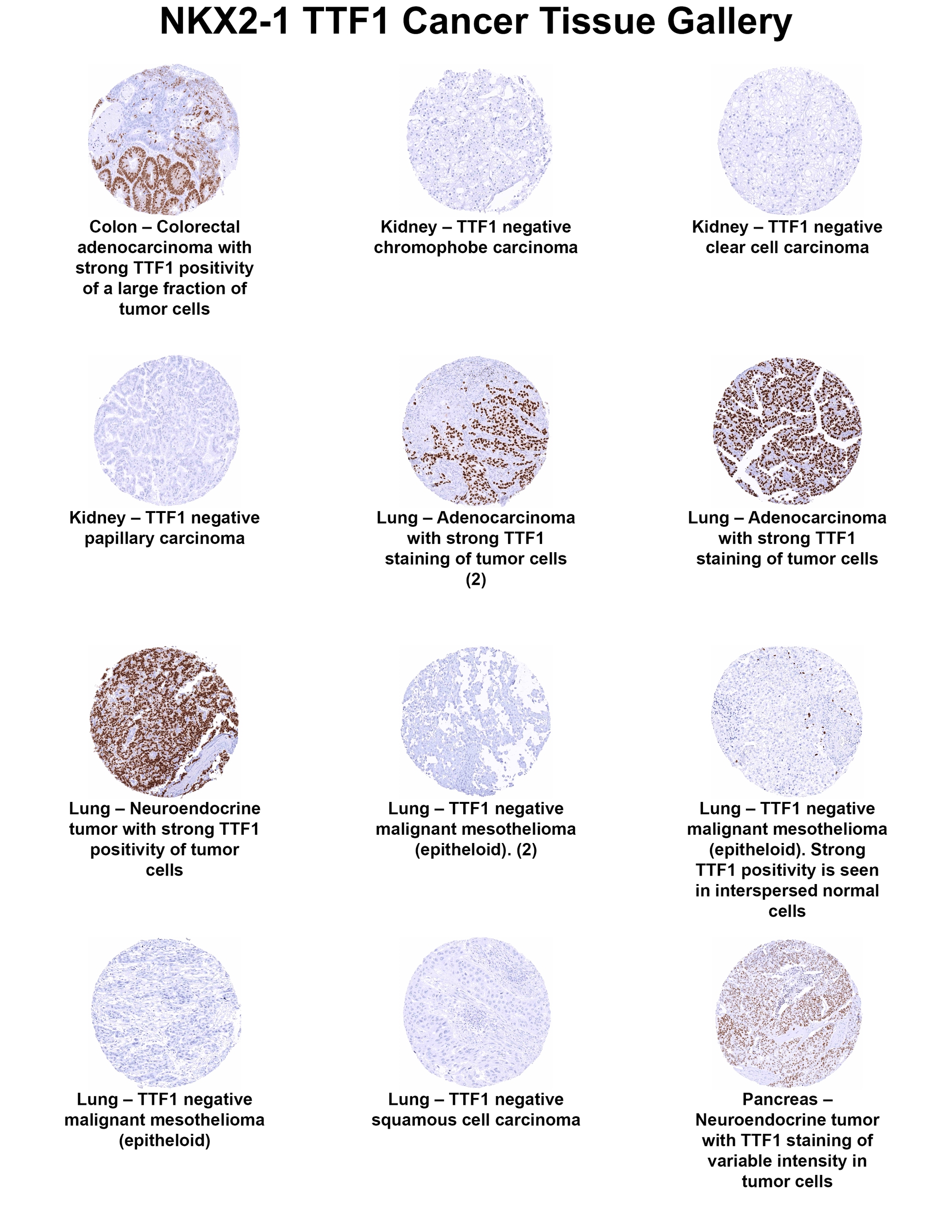 TTF-1 / NKX2-1 Antibody (MSVA-312R) - Azide and BSA Free TTF-1 / NKX2-1 Antibody (MSVA-312R) - Azide and BSA Free TTF-1 / NKX2-1 Cancer Tissue Gallery