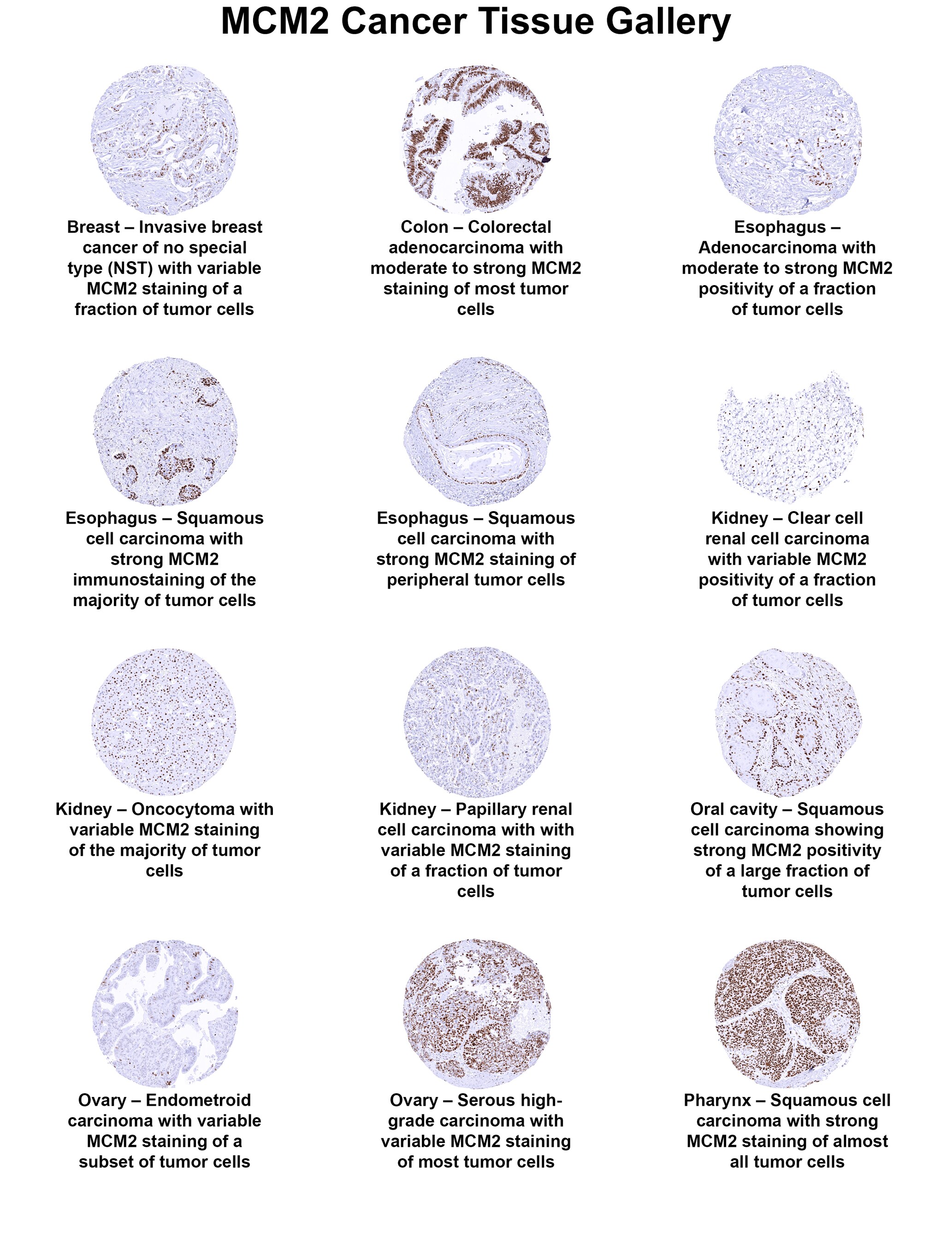 MCM2 Antibody (MSVA-502R) - Azide and BSA Free MCM2 Antibody (MSVA-502R) - Azide and BSA Free MCM2 Cancer Tissue Gallery