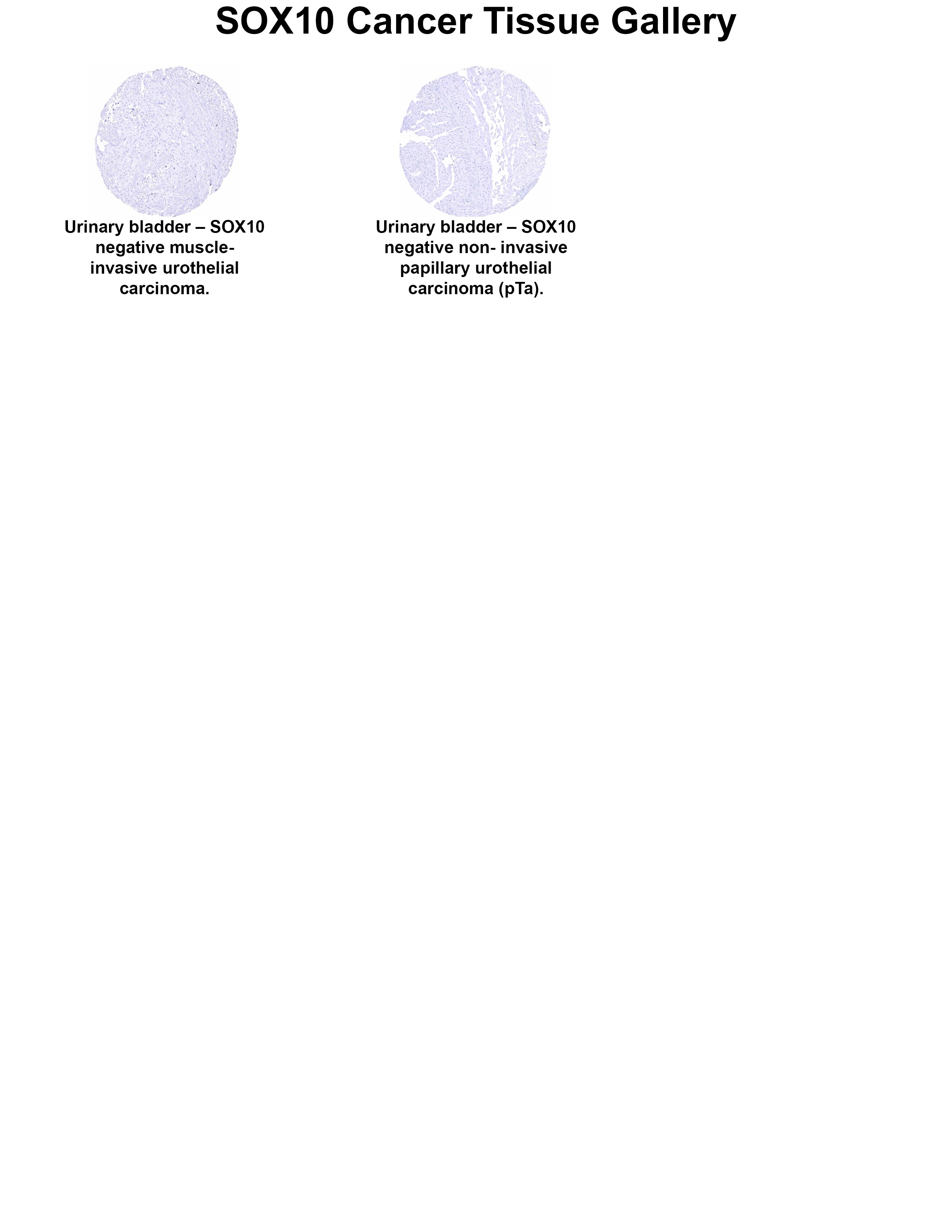 SOX10 Antibody (MSVA-710R) - Azide and BSA Free SOX10 Antibody (MSVA-710R) - Azide and BSA Free SOX10 Cancer Tissue Gallery