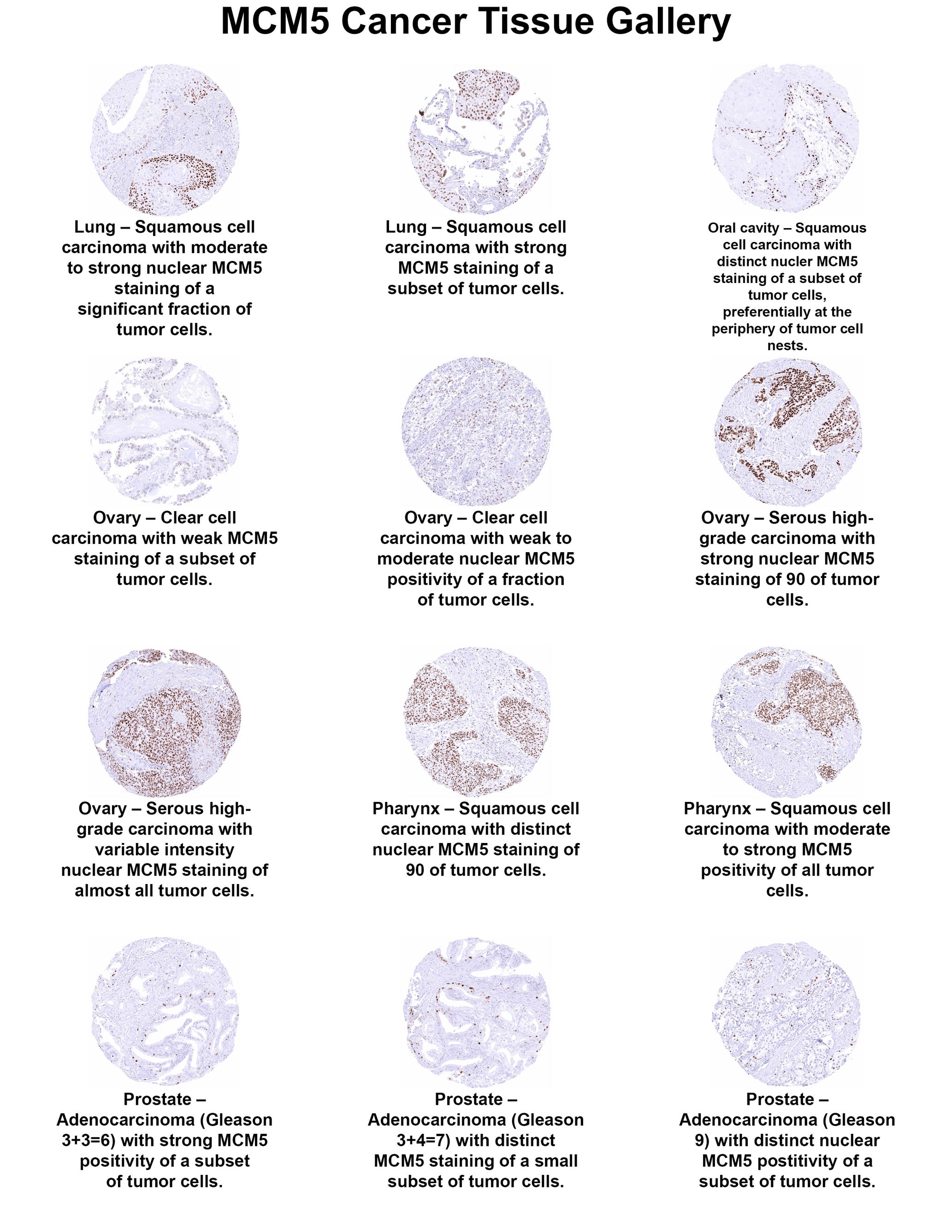 MCM5 Antibody (MSVA-505R) - Azide and BSA Free MCM5 Antibody (MSVA-505R) - Azide and BSA Free MCM5 Cancer Tissue Gallery