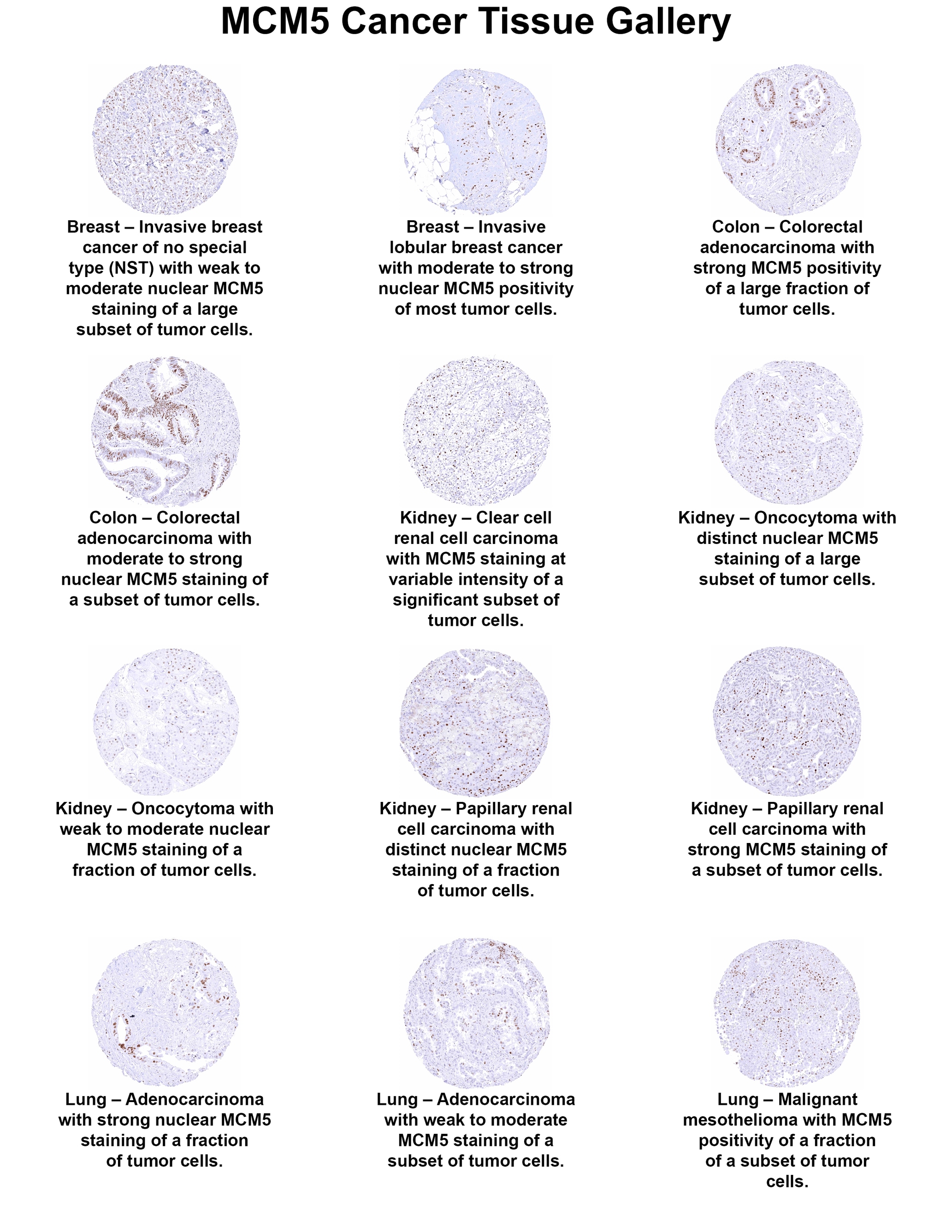 MCM5 Antibody (MSVA-505R) - Azide and BSA Free MCM5 Antibody (MSVA-505R) - Azide and BSA Free MCM5 Cancer Tissue Gallery