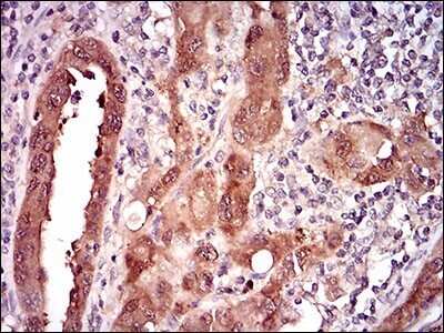 Immunohistochemical Staining of p16INK4a/CDKN2A in Paraffin Embedded Endometrial Cancer