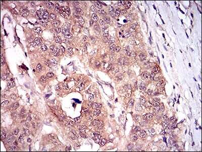 Immunohistochemical Staining of p16INK4a/CDKN2A in Paraffin Embedded Esophageal Cancer