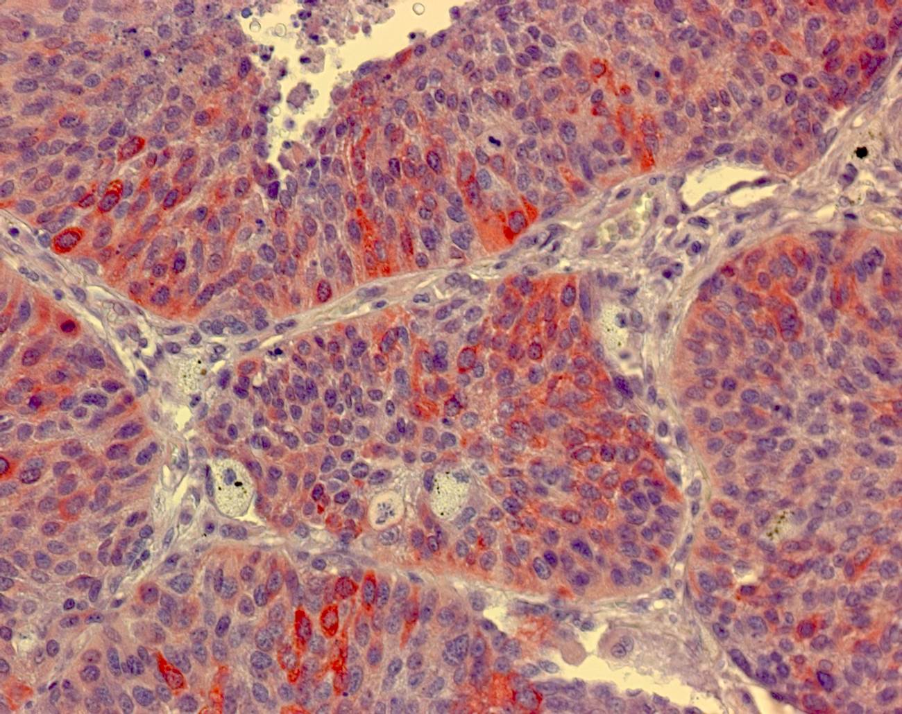 Human Lung Tissue MicroArray (Cancer) NBP2-30277