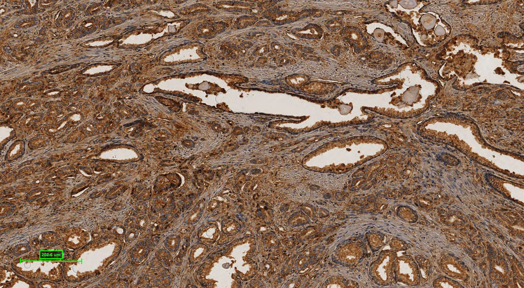 Human Prostate Tissue MicroArray (Cancer) NBP2-30169