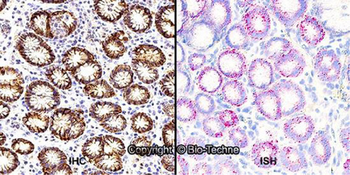 Figure 1. Dual RNAscope ISH-IHC showing expression of carbonic anhydrase IX/CA9.