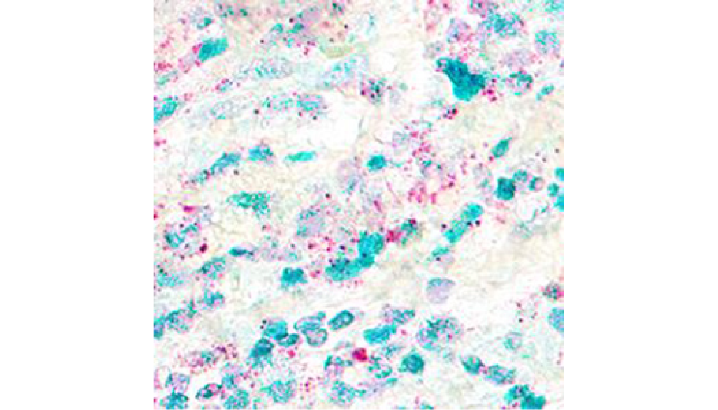 Figure 2. Dual RNAscope ISH/IHC showing co-detection of CD4 and FOXP3 in human breast cancer.