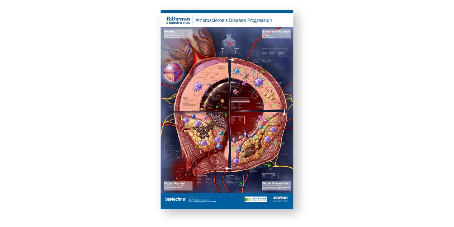 Atherosclerosis Disease Progression Cell Markers