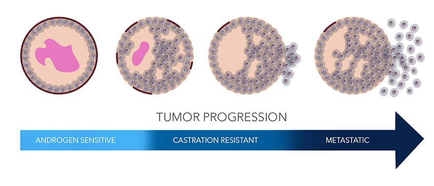 Prostate Cancer Tumor Progression